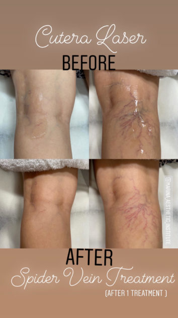 Laser Vein Therapy - Marina Aesthetic Institute